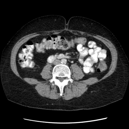 CT Scan