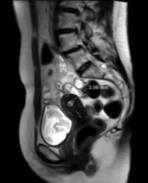 Endometrium MRI