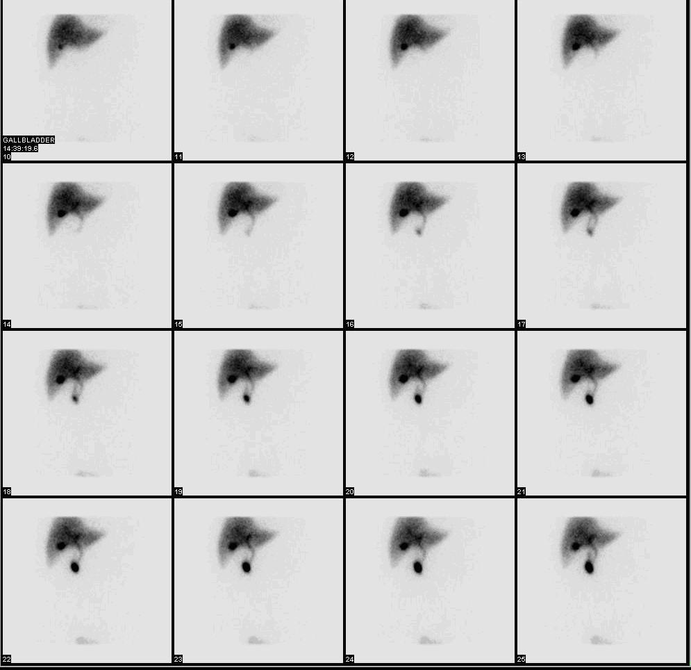 HIDA Nuclear Medicine Scan