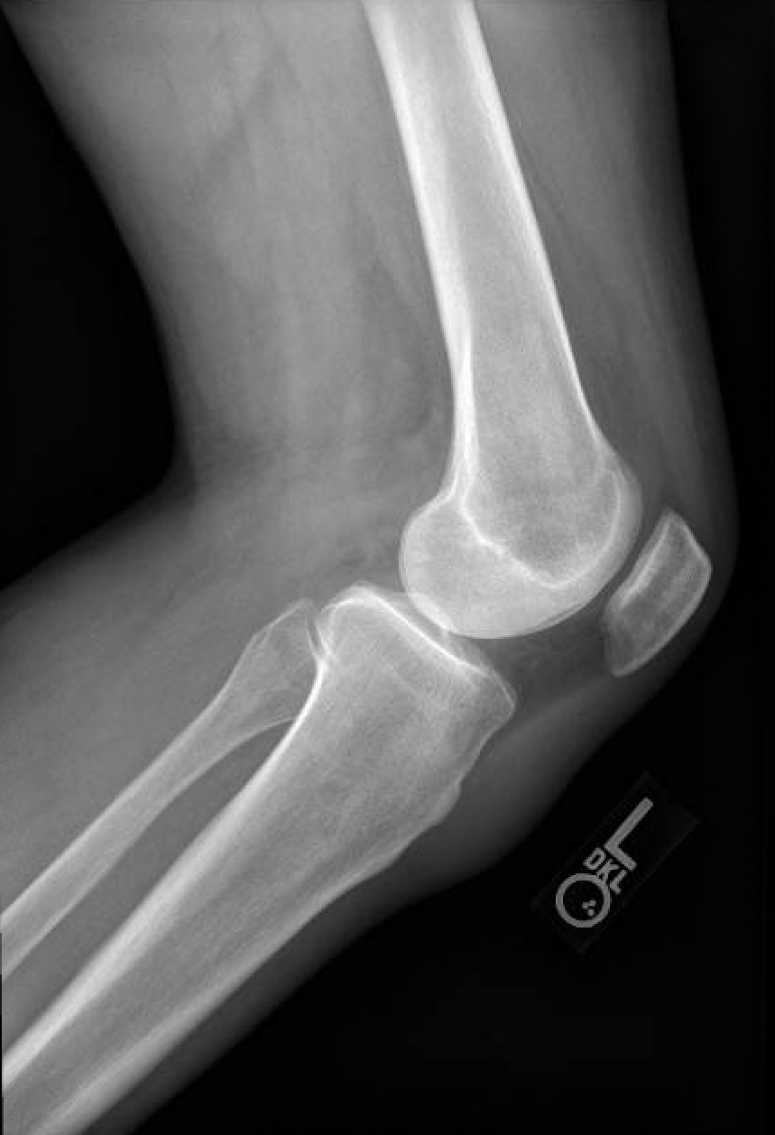 Knee X-Ray Lateral View