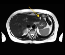 Liver MRI showing benign cyst