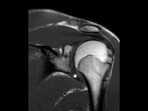 Shoulder MRI