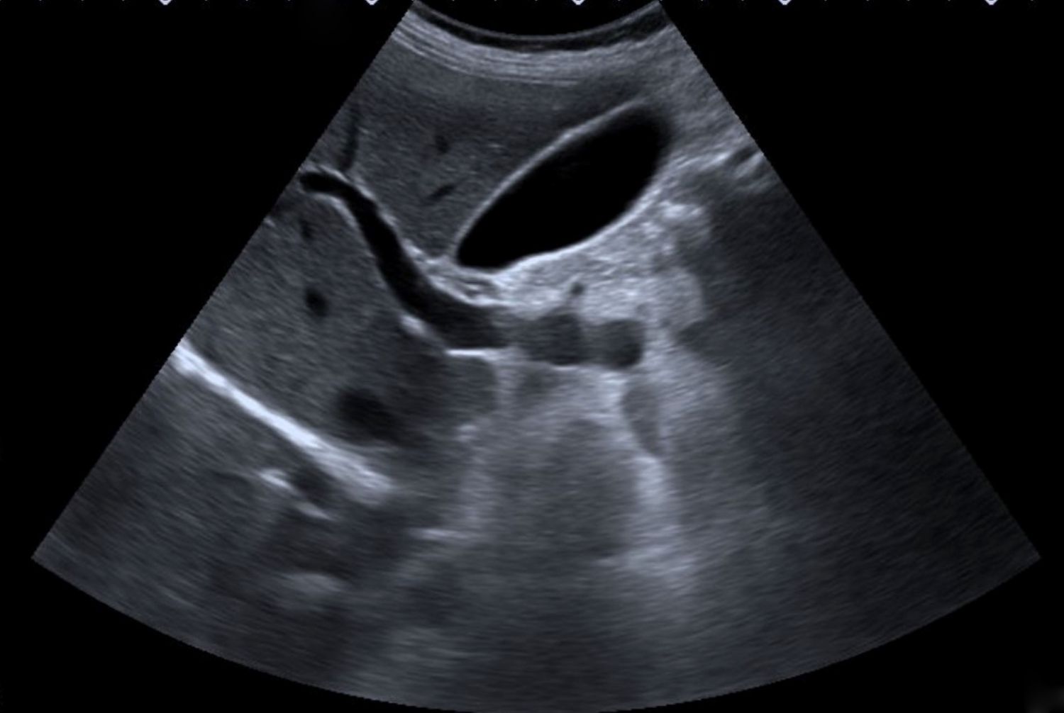 Gallbladder Ultrasound